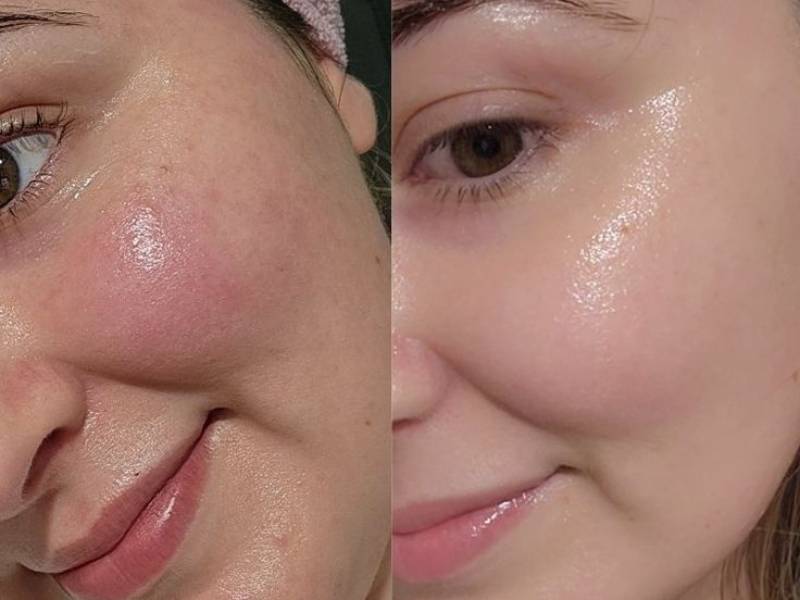 تاثیر آبرسانی بر روی پوست دهیدراته